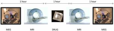 A MEG Study of Acute Arbaclofen (STX-209) Administration